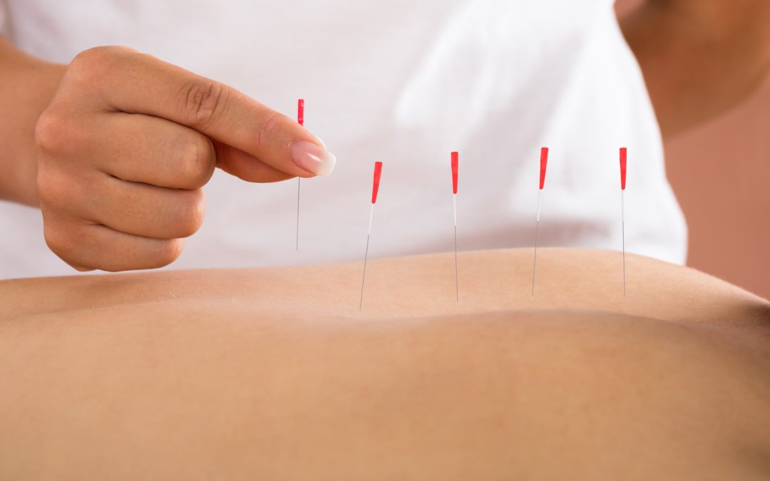 The Latest Research on Dry Needling: Benefits for Pain Relief and Muscle Recovery